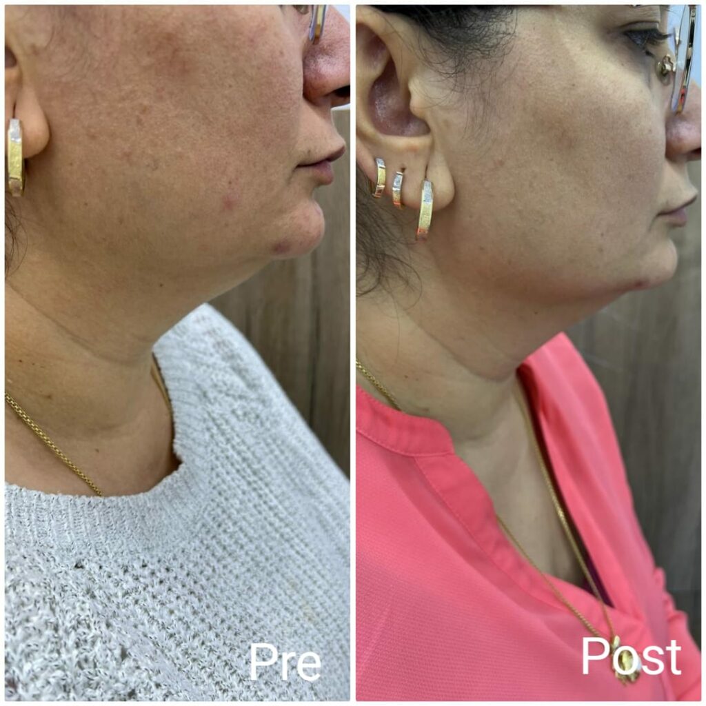 تحديد ونحت الفك بالهايفو جلسة واحدة